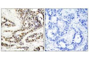 Immunohistochemical analysis of paraffin-embedded human breast carcinoma tissue using CREB(Phospho-Ser129) Antibody(left) or the same antibody preincubated with blocking peptide(right). (CREB1 Antikörper  (pSer129))