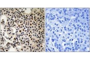 Immunohistochemistry analysis of paraffin-embedded human breast carcinoma, using PAK2 (Phospho-Ser197) Antibody. (PAK2 Antikörper  (pSer197))