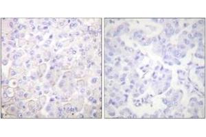 Immunohistochemistry analysis of paraffin-embedded human breast carcinoma tissue, using Cadherin-pan Antibody. (Cadherin Antikörper  (AA 833-882))