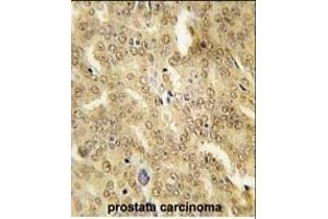 Formalin-fixed and paraffin-embedded human prostata carcinoma tissue reacted with HSP40 Antibody (ABIN1882092 and ABIN2846365) , which was peroxidase-conjugated to the secondary antibody, followed by DAB staining. (DNAJB1 Antikörper)