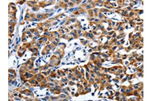 The image on the left is immunohistochemistry of paraffin-embedded Human lung cancer tissue using ABIN7191255(LAMA1 Antibody) at dilution 1/25, on the right is treated with synthetic peptide. (Laminin alpha 1 Antikörper)
