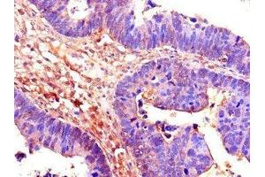 Immunohistochemistry of paraffin-embedded human ovarian cancer using ABIN7158853 at dilution of 1:100 (CDC25B Antikörper  (AA 1-195))
