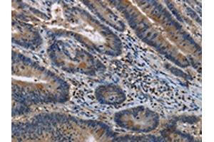 The image on the left is immunohistochemistry of paraffin-embedded Human colon cancer tissue using ABIN7191144(ITPR2 Antibody) at dilution 1/40, on the right is treated with synthetic peptide. (ITPR2 Antikörper)