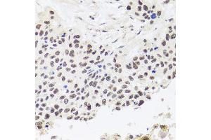 Immunohistochemistry of paraffin-embedded human lung cancer using RPP30 antibody at dilution of 1:100 (x40 lens). (RPP30 Antikörper)