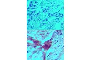 Immunohistochemical analysis of ARHGDIB monoclonal antibody, clone 97A1015  in formalin-fixed, paraffin-embedded human breast tumor tissue using an isotype control (top) and ARHGDIB monoclonal antibody, clone 97A1015  (bottom) at 5 ug/mL . (ARHGDIB Antikörper  (Cleavage Site))