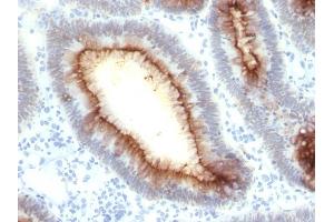 Formalin-fixed, paraffin-embedded human Colon Carcinoma stained with CEA Mouse Recombinant Monoclonal Antibody (rC66/1009). (Rekombinanter CEACAM5 Antikörper)