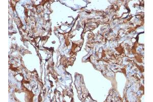Formalin-fixed, paraffin-embedded human Melanoma stained with MUC18 Mouse Monoclonal Antibody (MUC18/1130). (MCAM Antikörper)