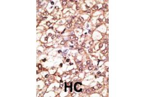 Formalin-fixed and paraffin-embedded human hepatocellular carcinoma tissue reacted with KREMEN1 polyclonal antibody , which was peroxidase-conjugated to the secondary antibody, followed by AEC staining.