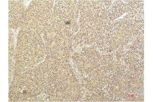 Immunohistochemical analysis of paraffin-embedded Human Kidney Carcinoma Tissue using SGK1 Mouse mAb diluted at 1:200. (SGK1 Antikörper  (AA 350-430))