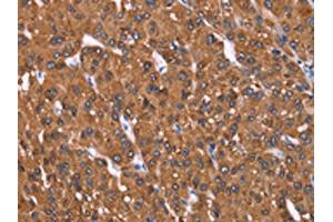 The image on the left is immunohistochemistry of paraffin-embedded Human liver cancer tissue using ABIN7191000(HRASLS2 Antibody) at dilution 1/40, on the right is treated with synthetic peptide. (HRASLS2 Antikörper)
