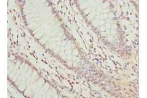 Immunohistochemistry of paraffin-embedded human colon cancer using ABIN7157970 at dilution of 1: 100 (LEFTY2 Antikörper  (AA 57-366))