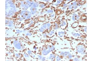 Formalin-fixed, paraffin-embedded human Colon Carcinoma stained with Vimentin Mouse Monoclonal Antibody (VIM/3736). (Vimentin Antikörper  (AA 2-466))