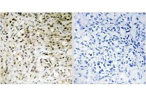 Immunohistochemistry analysis of paraffin-embedded human liver carcinoma tissue using TAF5 antibody. (TAF5 Antikörper)