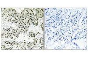 Immunohistochemistry analysis of paraffin-embedded human breast carcinoma tissue using THOC5 antibody. (THO Complex 5 Antikörper)