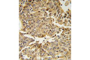 HIF1A Antibody (N-term) (ABIN650972 and ABIN2840017) IHC analysis in formalin fixed and paraffin embedded lung carcinoma followed by peroxidase conjugation of the secondary antibody and DAB staining. (HIF1A Antikörper  (N-Term))