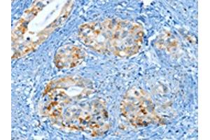 The image on the left is immunohistochemistry of paraffin-embedded Human cervical cancer tissue using ABIN7130299(MUC15 Antibody) at dilution 1/25, on the right is treated with fusion protein. (MUC15 Antikörper)