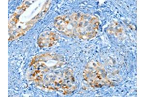 The image on the left is immunohistochemistry of paraffin-embedded Human cervical cancer tissue using ABIN7130299(MUC15 Antibody) at dilution 1/25, on the right is treated with fusion protein. (MUC15 Antikörper)