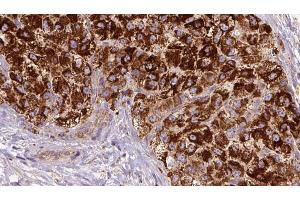 ABIN6272680 at 1/100 staining Human liver cancer tissue by IHC-P. (CCR3 Antikörper  (C-Term))