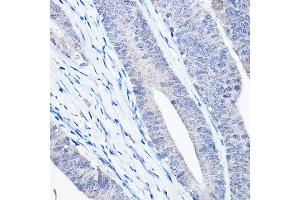 Immunohistochemistry of paraffin-embedded human colon carcinoma using Bax Rabbit mAb  at dilution of 1:25,1:50 (40x lens). (BAX Antikörper)