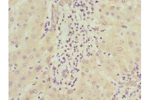 Immunohistochemistry of paraffin-embedded human liver cancer using ABIN7156542 at dilution of 1:100 (ICAM4 Antikörper  (AA 20-140))
