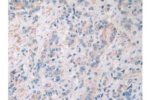 IHC-P analysis of Human Prostate Gland Cancer Tissue, with DAB staining. (SIRT4 Antikörper  (AA 28-314))