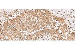 Immunohistochemistry of paraffin-embedded Human esophagus cancer tissue using RCHY1 Polyclonal Antibody at dilution of 1:50(x200) (RCHY1 Antikörper)