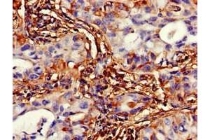 Immunohistochemistry of paraffin-embedded human lung cancer using ABIN7175344 at dilution of 1:100 (VMP1 Antikörper  (AA 136-235))