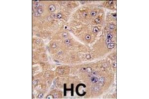Formalin-fixed and paraffin-embedded human hepatocarcinoma tissue reacted with FUCA2 antibody (N-term) (ABIN391985 and ABIN2841774) , which was peroxidase-conjugated to the secondary antibody, followed by DAB staining.