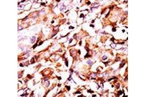 IHC analysis of FFPE human breast carcinoma tissue stained with the phospho-Bad antibody. (BAD Antikörper  (pSer99))
