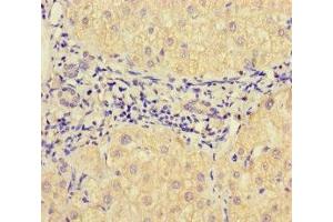 Immunohistochemistry of paraffin-embedded human liver cancer using ABIN7175471 at dilution of 1:100