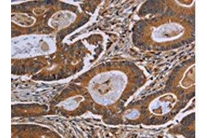 The image on the left is immunohistochemistry of paraffin-embedded Human colon cancer tissue using ABIN7190808(GJB4 Antibody) at dilution 1/40, on the right is treated with synthetic peptide. (GJB4 Antikörper)