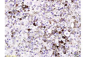 Formalin-fixed and paraffin embedded mouse melanoma labeled with Anti- MITF Polyclonal Antibody, Unconjugated (ABIN676373) at 1:200 followed by conjugation to the secondary antibody and DAB staining (MITF Antikörper  (AA 351-450))