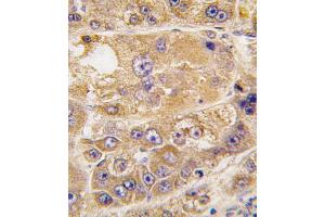 Formalin-fixed and paraffin-embedded human hepatocarcinoma tissue reacted with LDLRAP1 antibody , which was peroxidase-conjugated to the secondary antibody, followed by DAB staining. (LDLRAP1 Antikörper  (C-Term))