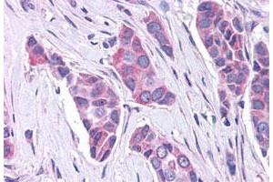 Immunohistochemistry (Formalin/PFA-fixed paraffin-embedded sections) of human breast cancer tissue with GPER polyclonal antibody . (GPER Antikörper  (C-Term))