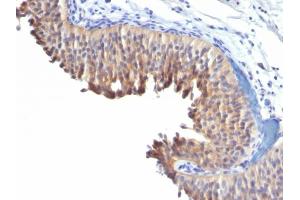 Formalin-fixed, paraffin-embedded human Bladder Carcinoma stained with Cytokeratin 10 Mouse Monoclonal Antibody (LH2). (Keratin 10 Antikörper)