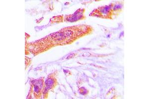 Immunohistochemical analysis of PSMD6 staining in human lung cancer formalin fixed paraffin embedded tissue section. (PSMD6 Antikörper  (Center))
