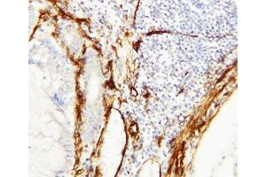 IHC-P: Caveolin-1 antibody testing of human breast cancer tissue