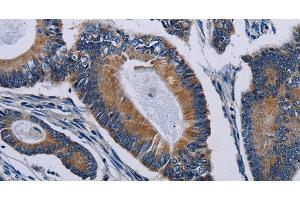 Immunohistochemistry of paraffin-embedded Human colon cancer tissue using PCDHAC2 Polyclonal Antibody at dilution 1:50 (PCDHAC2 Antikörper)