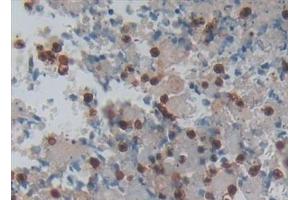 Detection of PP13 in Human Lung cancer Tissue using Polyclonal Antibody to Placental Protein 13 (PP13) (LGALS13 Antikörper  (AA 1-139))