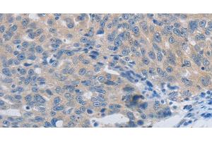 Immunohistochemistry of paraffin-embedded Human ovarian cancer using MMP8 Polyclonal Antibody at dilution of 1:45 (MMP8 Antikörper)