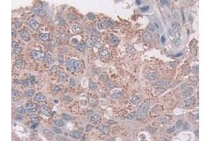 Detection of CXADR in Human Breast cancer Tissue using Polyclonal Antibody to Coxsackie Virus And Adenovirus Receptor (CXADR) (Coxsackie Adenovirus Receptor Antikörper  (AA 20-229))