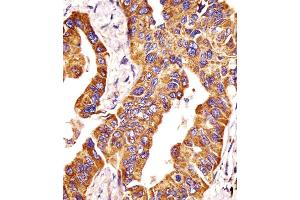 Antibody staining MMP14 in human lung adenocarcinoma tissue sections by Immunohistochemistry (IHC-P - paraformaldehyde-fixed, paraffin-embedded sections). (MMP14 Antikörper  (N-Term))