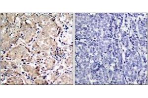 Immunohistochemistry analysis of paraffin-embedded human breast carcinoma, using FKHR (Phospho-Ser319) Antibody. (FOXO1 Antikörper  (pSer319))
