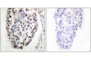 Immunohistochemistry analysis of paraffin-embedded human breast carcinoma tissue, using MYF5 (Ab-49) Antibody. (MYF5 Antikörper  (AA 21-70))