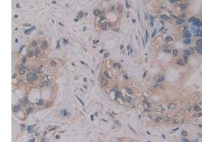 Detection of MPG1 in Human Liver cancer Tissue using Polyclonal Antibody to Macrophage Expressed Gene 1 Protein (MPG1) (MPEG1 Antikörper  (AA 313-580))