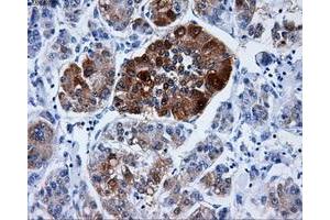 Immunohistochemical staining of paraffin-embedded Carcinoma of liver tissue using anti-DCXRmouse monoclonal antibody. (DCXR Antikörper)