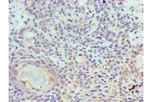 Immunohistochemistry of paraffin-embedded human breast cancer using ABIN7150350 at dilution of 1:100