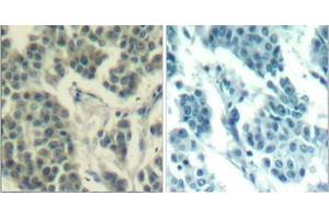 Immunohistochemical analysis of paraffin- embedded human breast carcinoma tissue using Her3/ErbB3 (phospho-Tyr1328) Antibody (E011510) . (ERBB3 Antikörper  (pTyr1328))