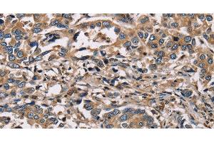 Immunohistochemistry of paraffin-embedded Human liver cancer using HSD17B12 Polyclonal Antibody at dilution of 1:30 (HSD17B12 Antikörper)