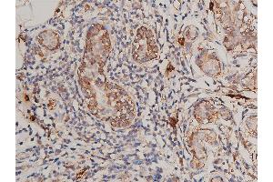 ABIN6269175 at 1/200 staining human breast cancer tissue sections by IHC-P.